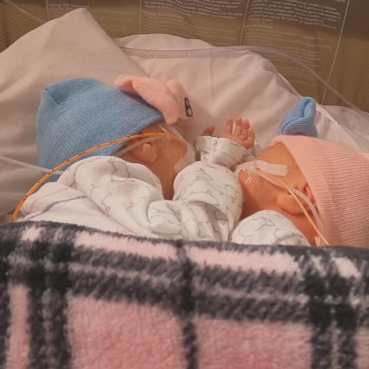 CONJOINED TWINS BORN IN LOUISVILLE